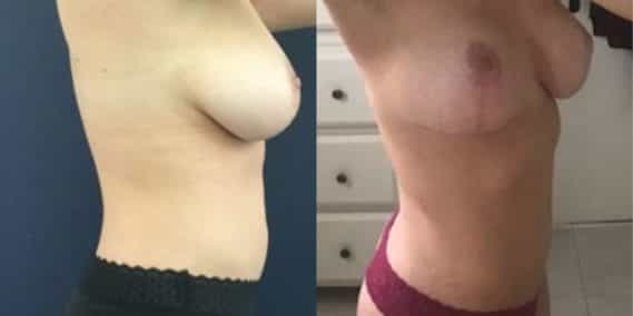 liposuction colombia 215 - 3-min