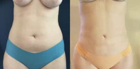 liposuction colombia 218 - 1-min