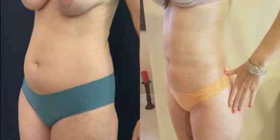 liposuction colombia 218 - 2-min