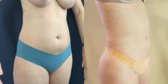 liposuction colombia 218 - 4-min