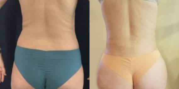 liposuction colombia 218 - 6-min