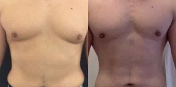 liposuction colombia 223 - 1-min