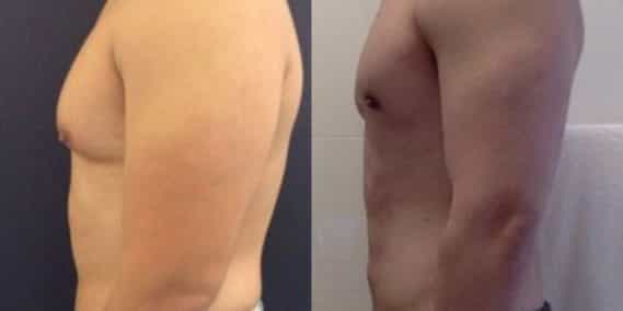 liposuction colombia 223 - 3-min