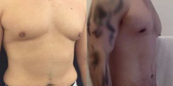 liposuction colombia 223 - 4-min