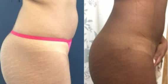 liposuction colombia 225 - 3-min