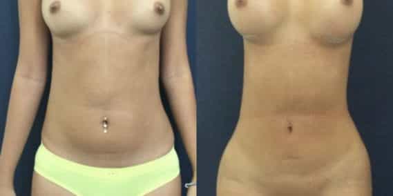 liposuction colombia 231 - 1-min