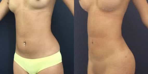 liposuction colombia 231 - 2-min