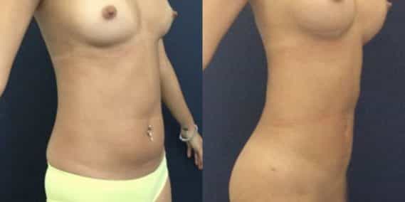 liposuction colombia 231 - 5-min