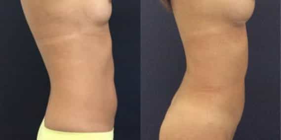 liposuction colombia 231 - 7-min