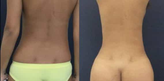 liposuction colombia 231 - 8-min