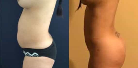 liposuction colombia 242 - 3-min