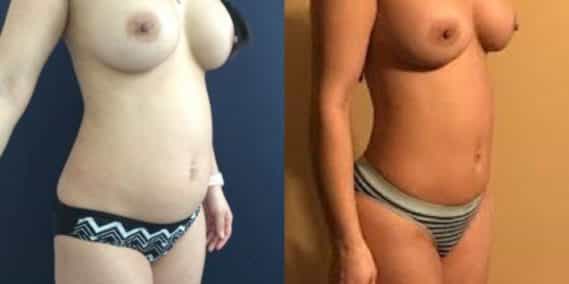 liposuction colombia 242 - 4-min
