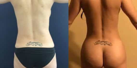 liposuction colombia 242 - 6-min