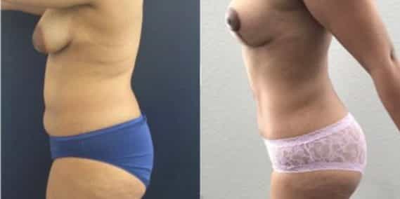 liposuction colombia 244 - 2-min