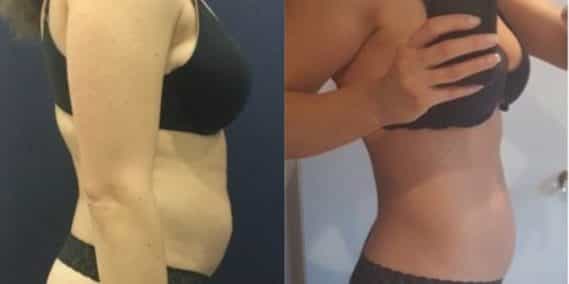 liposuction colombia 247 - 4-min