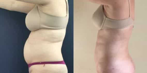 liposuction colombia 248 - 2-min