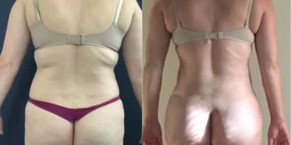 liposuction colombia 248 - 4-min