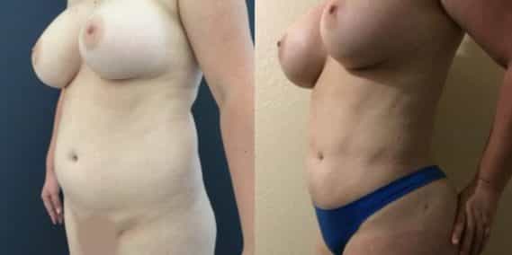 liposuction colombia 251 - 2-min