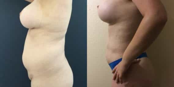 liposuction colombia 251 - 3-min