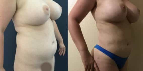 liposuction colombia 251 - 4-min
