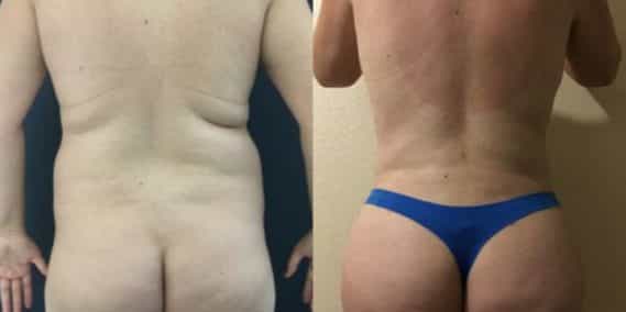 liposuction colombia 251 - 6-min