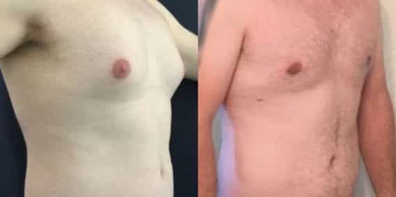 liposuction colombia 258 - 4-min