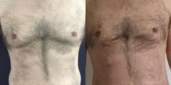 liposuction colombia 260 - 1-min