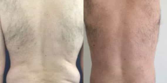 liposuction colombia 260 - 6-min