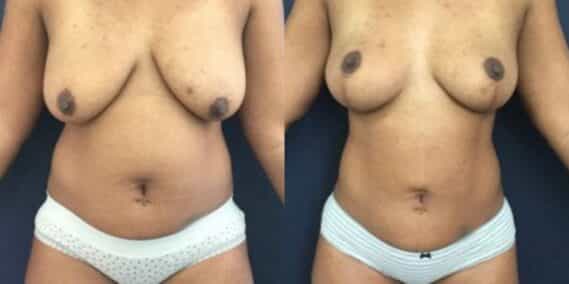 liposuction colombia 273 - 1-min