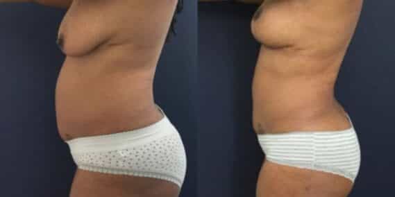liposuction colombia 273 - 2-min