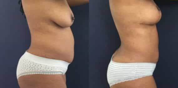 liposuction colombia 273 - 3-min