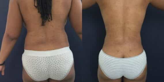 liposuction colombia 273 - 4-min