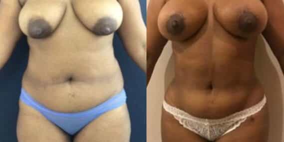 liposuction colombia 279 - 1-min
