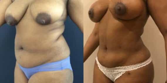 liposuction colombia 279 - 2-min