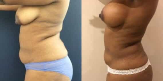liposuction colombia 279 - 3-min