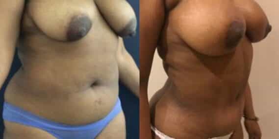 liposuction colombia 279 - 4-min