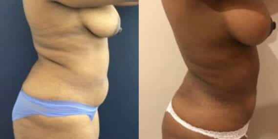 liposuction colombia 279 - 5-min