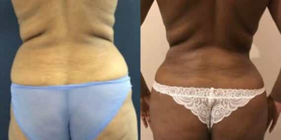liposuction colombia 279 - 6-min