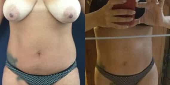 liposuction colombia 281 - 1-min