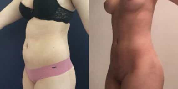 liposuction colombia 304 - 2-min