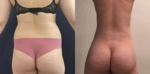 liposuction colombia 304 - 6-min