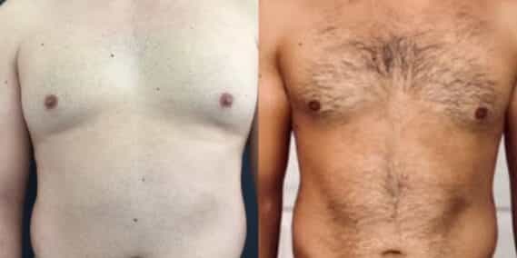 liposuction colombia 323 - 1-min