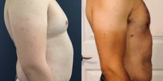liposuction colombia 323 - 3-min