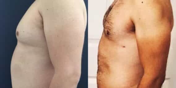 liposuction colombia 323 - 5-min