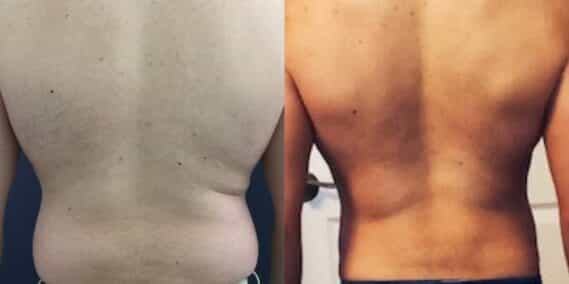 liposuction colombia 323 - 6-min