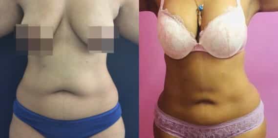 liposuction colombia 331 - 1-min