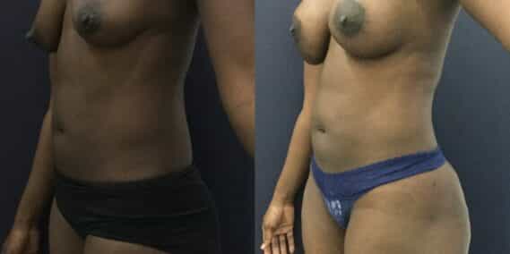 liposuction colombia 343 - 2-min