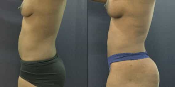 liposuction colombia 343 - 3-min