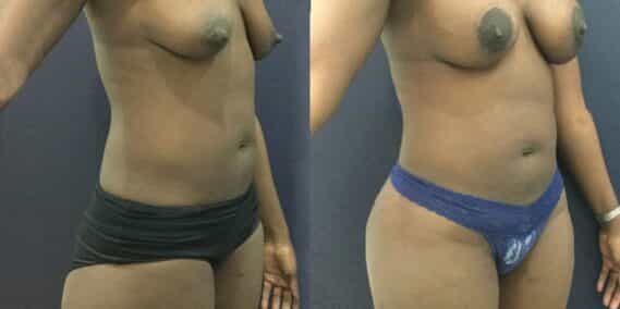 liposuction colombia 343 - 4-min