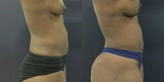 liposuction colombia 343 - 5-min